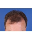 Before Hair Transplant&nbsp;Front